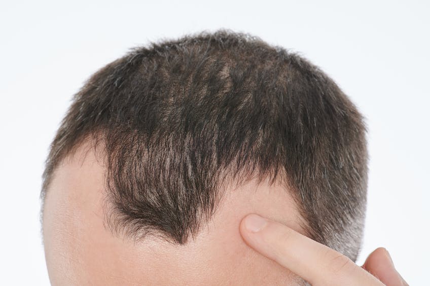 La carenza di certi nutrienti potrebbe portare alla caduta dei capelli?